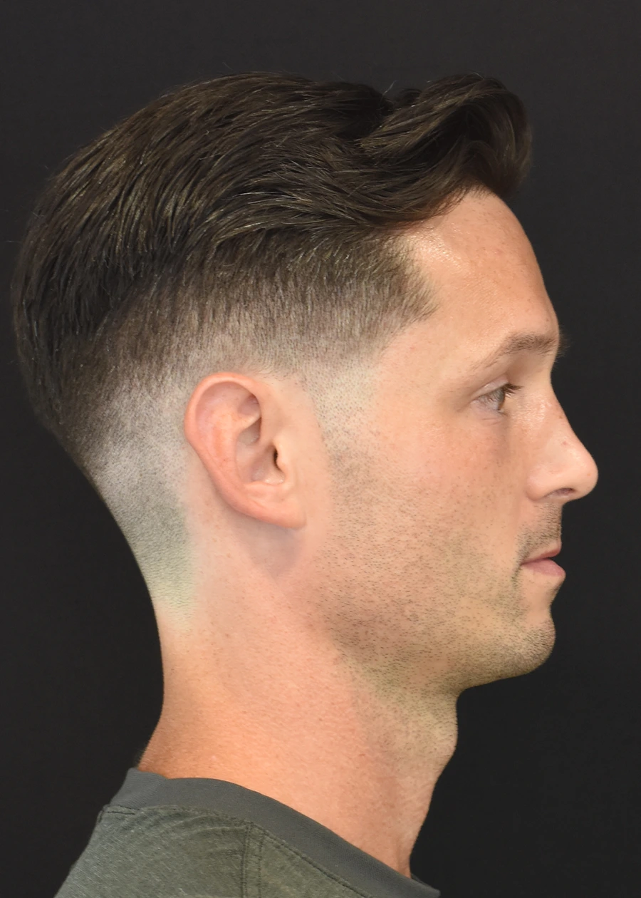 Rhinoplasty Patient 7 Set 3 After