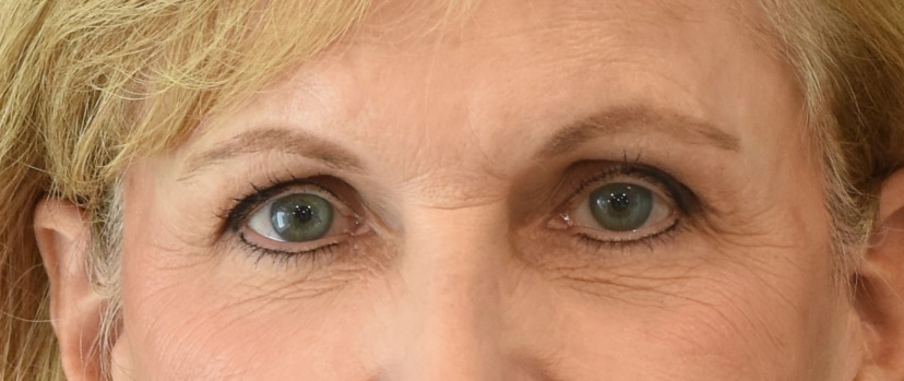 Brow Lift Patient 4 Set 1 After